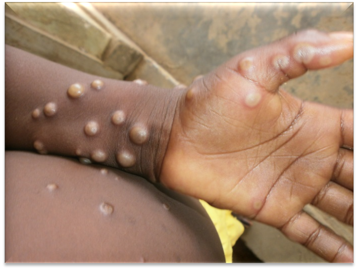 Africa CDC declares Mpox Public Health Emergency as cases exceed 40,000